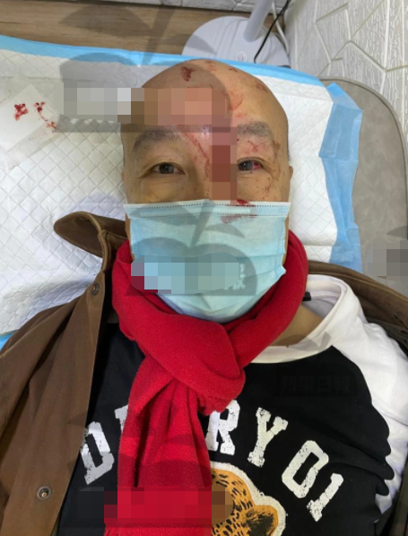 71岁老艺术家突遇意外！酒店内扑倒撞破头，紧急送医缝10针